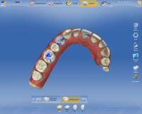 CEREC AC OMNICAM ПРОСТОЕ СКАНИРОВАНИЕ БЕЗ АНТИБЛИКОВОГО СПРЕЯ 16.jpg CEREC AC OMNICAM ПРОСТОЕ СКАНИРОВАНИЕ БЕЗ АНТИБЛИКОВОГО СПРЕЯ 16.jpg